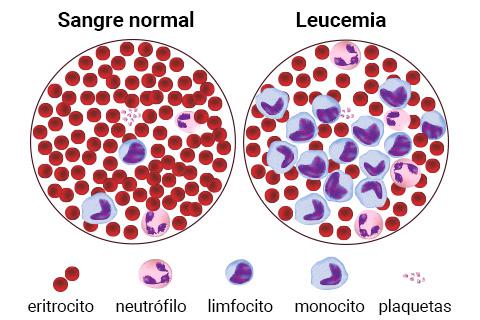 tipos-de-leucemia